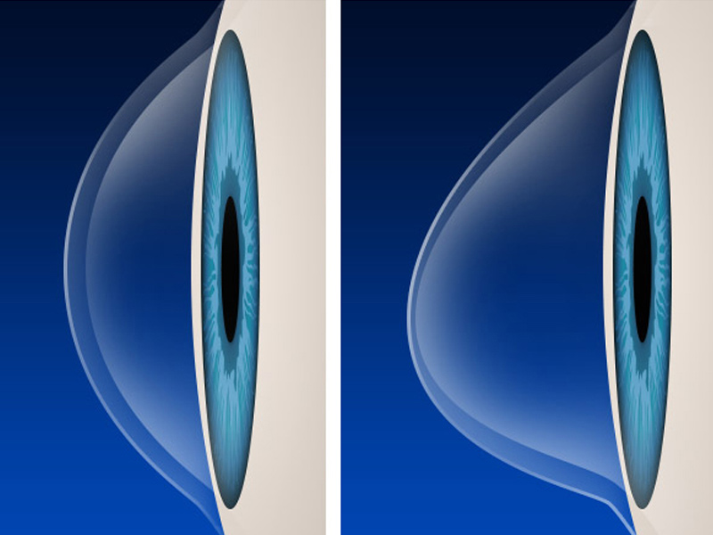 keratoconus - photo